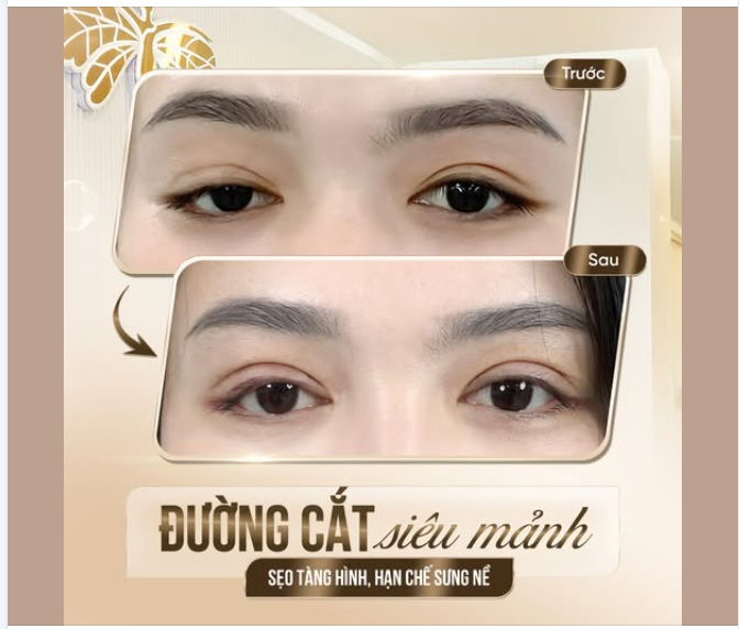 NHƯỢC CƠ, ĐỘ MỞ 2 MẮT KHÔNG ĐỀU Khiến vị khách hàng CHÁN NẢN, TỰ TI