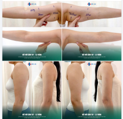 ƯU ĐÃI THÁNG 6 – HÚT MỠ CÁNH TAY GIẢM ĐẾN 40%  TẶNG MIỄN PHÍ HÚT MỠ NÁCH