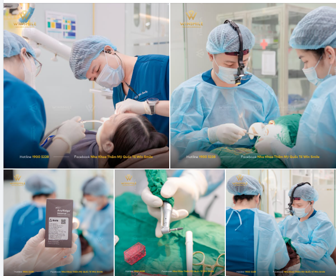 Implant là kỹ thuật phục hồi răng mất đòi hỏi độ chính xác cao, sử dụng vật liệu cấy ghép tồn tại trong cơ thể suốt nhiều năm.