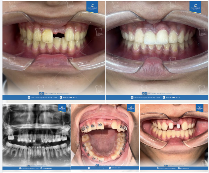 Nhìn răng hiện tại của bạn Quốc Toàn, ai nghĩ đây là răng đã trồng implant chứ?