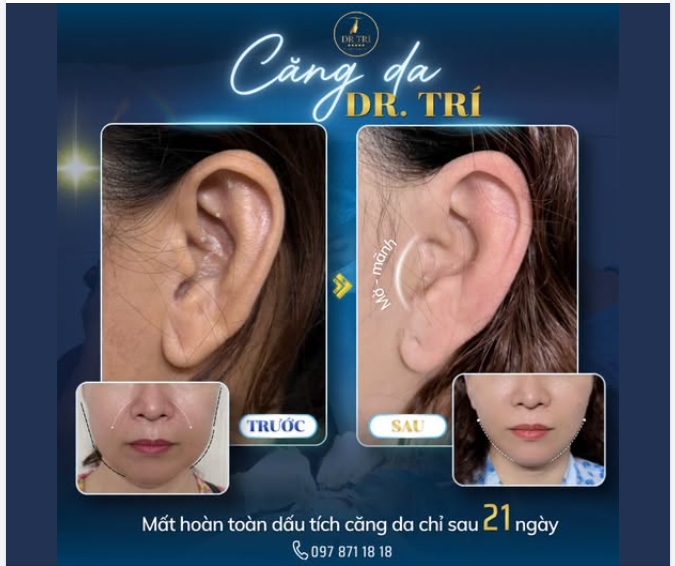 XÓA SẠCH RÃNH CƯỜI, PHỤC HỒI VIỀN HÀM V-LINE CHỈ SAU 21 NGÀY!