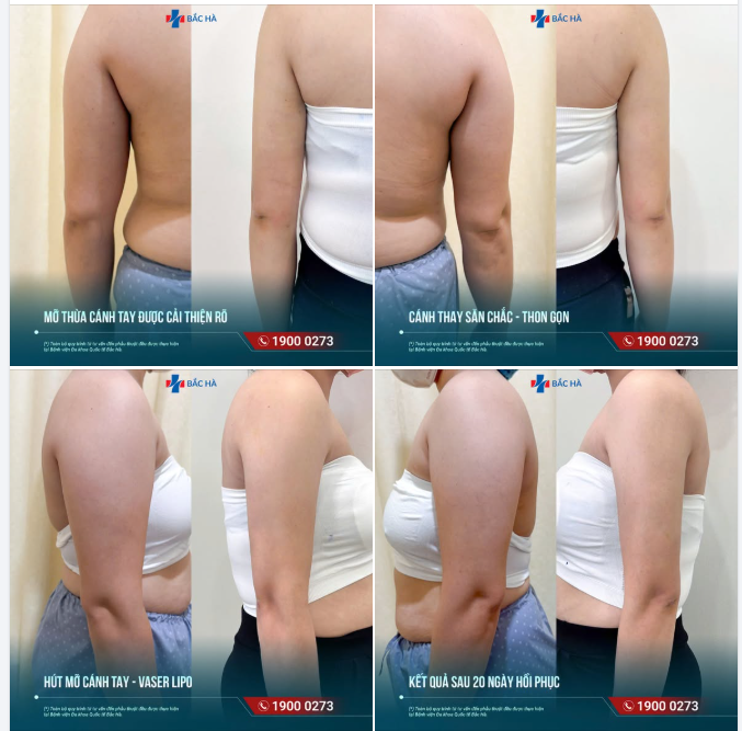 CÁNH TAY GỌN HƠN – DÁNG NGƯỜI NHẸ HƠN SAU KHI HÚT MỠ