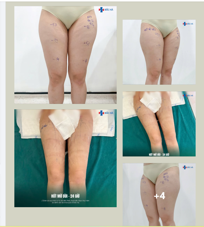 24 GIỜ SAU HÚT MỠ ĐÙI – SỰ THAY ĐỔI KHIẾN CHỊ KHÁCH BẤT NGỜ