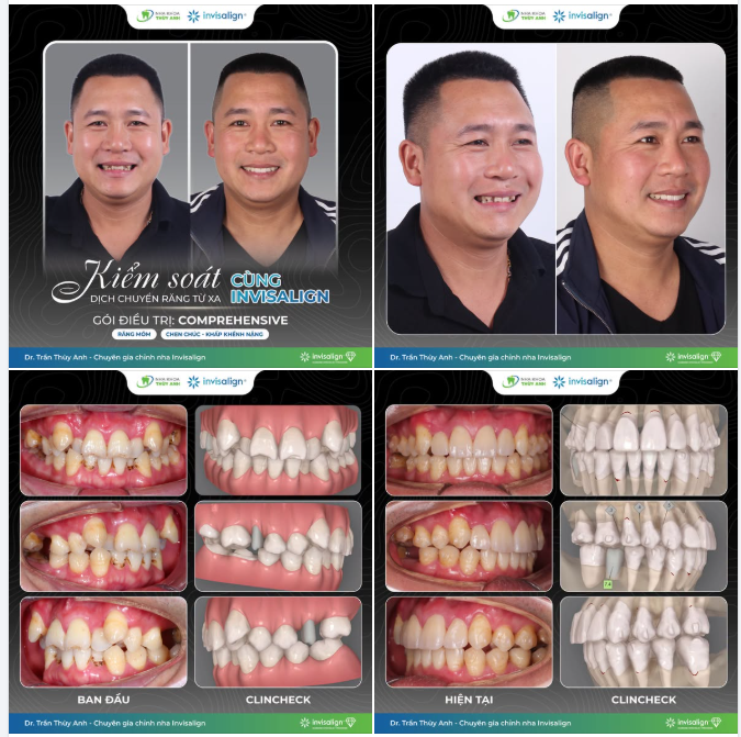 INVISALIGN COMPREHENSIVE: ĐIỀU TRỊ RĂNG CHEN CHÚC, KHẤP KHỂNH NẶNG - CA KHÔNG NHỔ RĂNG