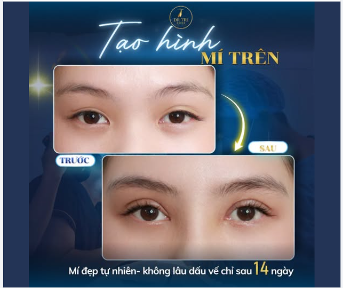 TẠM BIỆT MẮT MÍ LÓT – ĐÓN NẾP MÍ ĐẸP TỰ NHIÊN CHỈ SAU 14 NGÀY