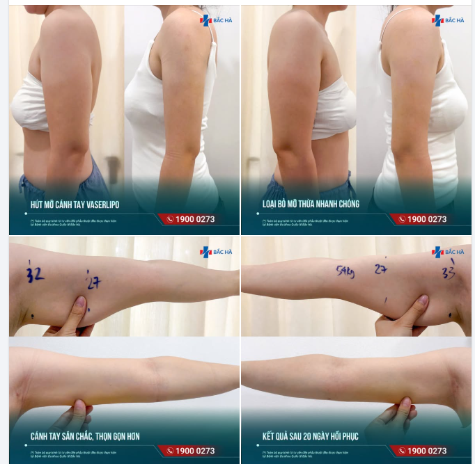 15 NGÀY SAU HÚT MỠ CÁNH TAY…