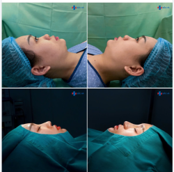KHI NÀO NÊN CHỌN NÂNG MŨI CẤU TRÚC?