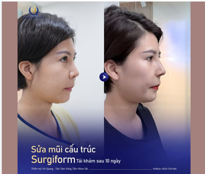 SỬA MŨI CẤU TRÚC SURGIFORM – DIỆN MẠO MỚI SAU 10 NGÀY