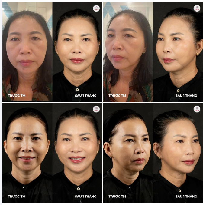 KẾT QUẢ SAU 1 THÁNG TIÊM 14CC FILLER MD CODES NHƯ THẾ NÀO?