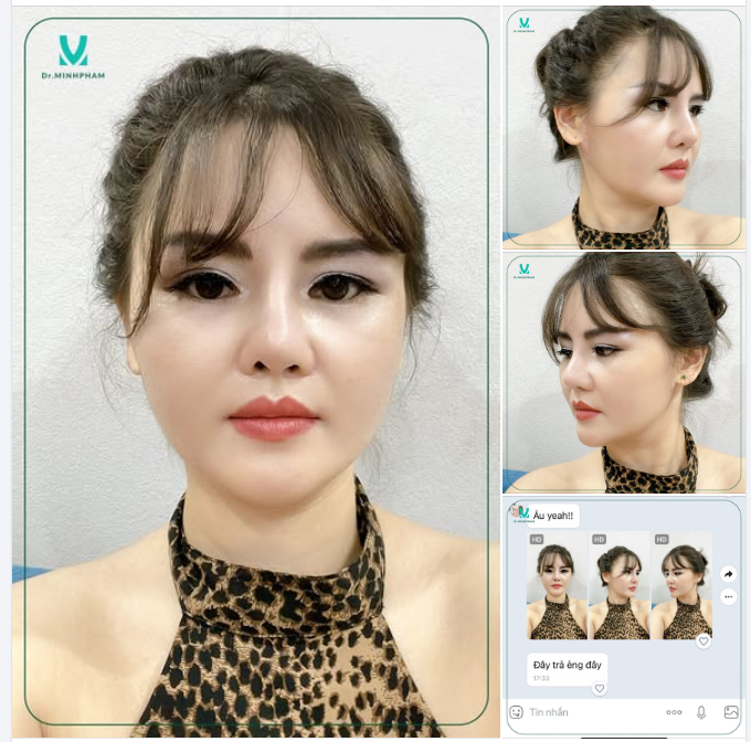 Trước khi biết đến gọt hàm thì nhìn mặt to, góc cạnh nhưng sau khi biết đến phương pháp gọt hàm tại Dr. Minh Phạm