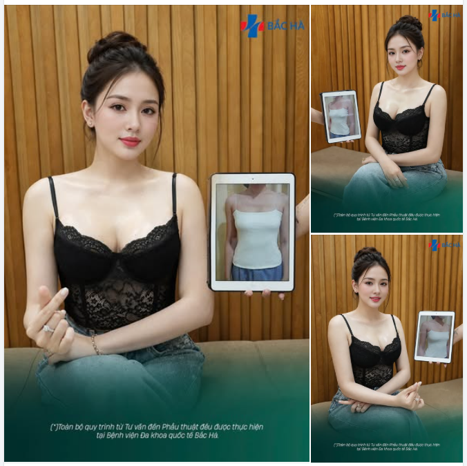 15 NGÀY SAU NÂNG NGỰC NANOCHIP ERGONOMIX 265CC - 285CC