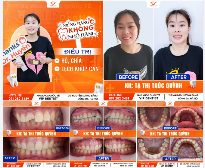 NIỀNG RĂNG KHÔNG NHỔ RĂNG - TỰ TIN RẠNG RỠ ĐÓN HÈ VỀ!