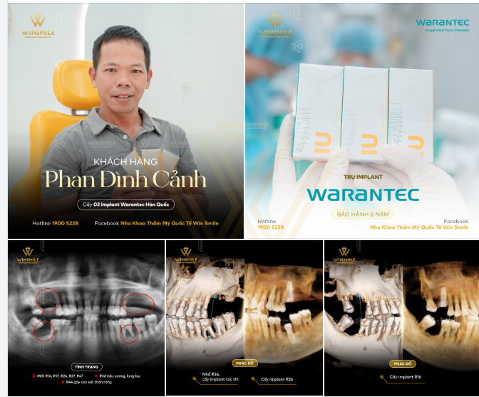 Mất nhiều răng không có nghĩa là phải điều trị một lần tất cả