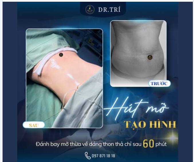 LẤY LẠI VÓC DÁNG HOÀN MỸ CHỈ SAU 60 PHÚT TẠI DR. TRÍ