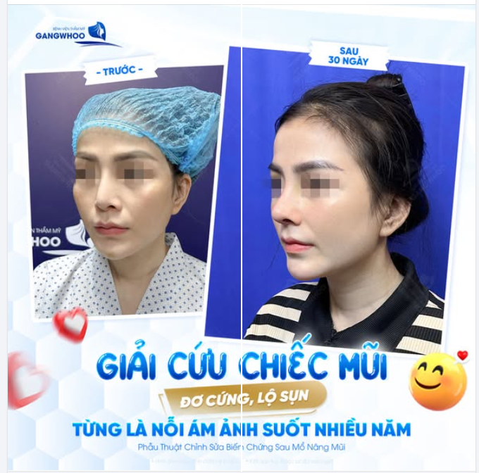 GIẢI CỨU CHIẾC MŨI ĐƠ CỨNG, LỘ SỤN