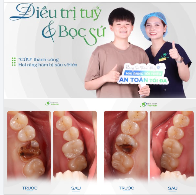 VÌ SAO NHA SĨ LUÔN CỐ GẮNG GIỮ RĂNG THẬT TRƯỚC KHI NGHĨ ĐẾN IMPLANT?