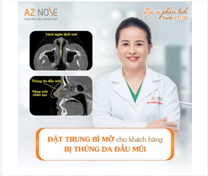 Tư vấn cho khách hàng từng nâng mũi nhân tạo gặp tình trạng viêm, thủng da đầu mũi.