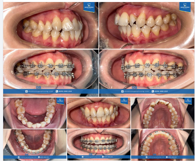 Niềng lại những chiếc răng nhảy múa cho bạn Nguyễn Hương