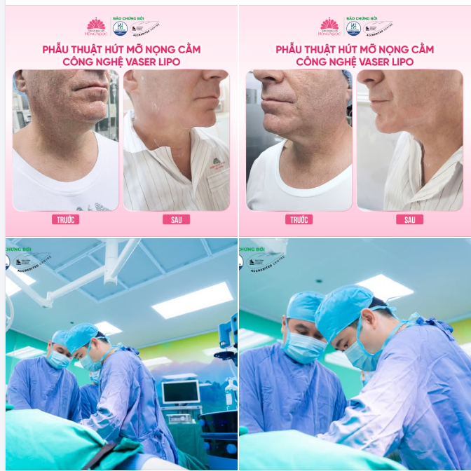 XÓA SỔ MỠ NỌNG CẰM, TẠO VIỀN HÀM THANH THOÁT với CN Vaser Lipo