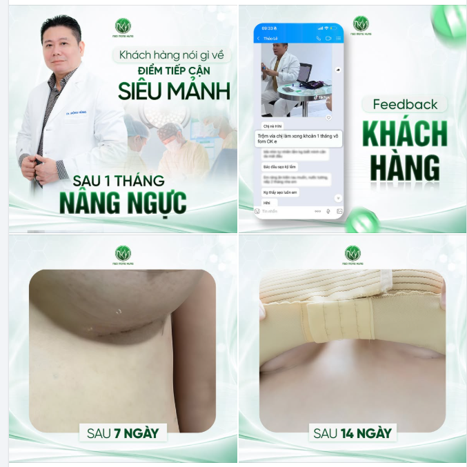 Khách hàng nói gì về điểm tiếp cận siêu mảnh sau 1 tháng nâng ngực?