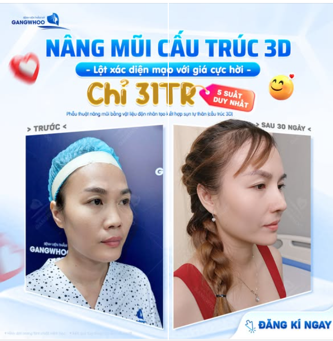 NÂNG MŨI CẤU TRÚC 3D