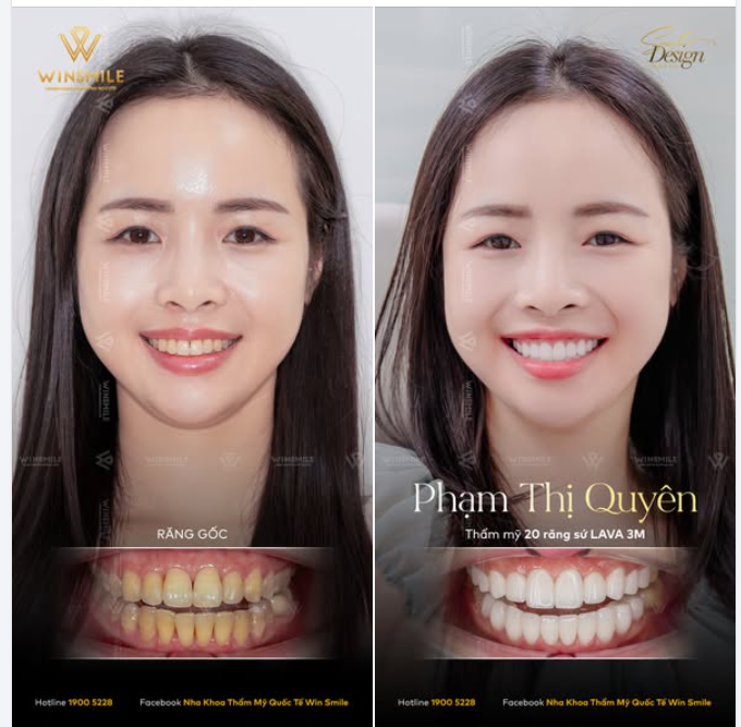 9 năm sống tại Hàn Quốc - nơi mà chuẩn mực cái đẹp được định nghĩa và cập nhật mỗi ngày, chị Quyên có đủ mọi cơ hội để chạm tay vào những công nghệ làm đẹp tiên tiến nhất.
