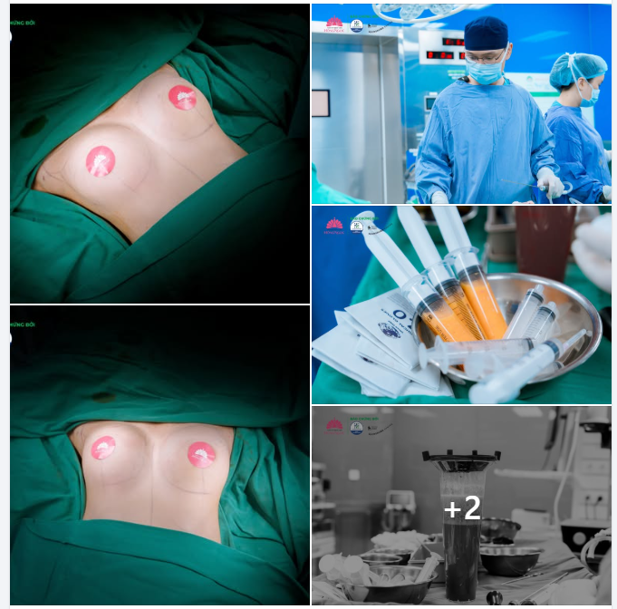 NÂNG NGỰC BẰNG MỠ TỰ THÂN - Sở hữu vòng 1 đẹp căng tròn, mềm mại, tự nhiên