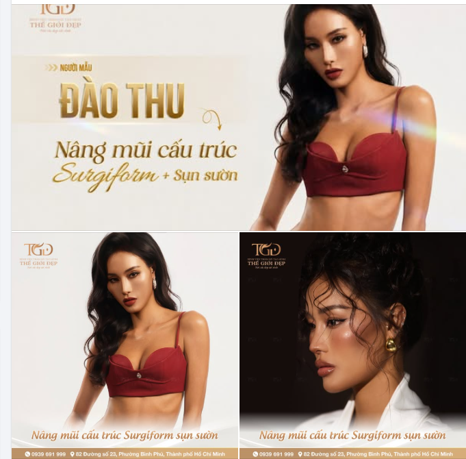 Lần thứ 3 tái phẫu thuật – Người mẫu Đào Thu chạm đến vẻ đẹp hài hòa với mũi cấu trúc sụn sườn kết hợp thanh Surgiform