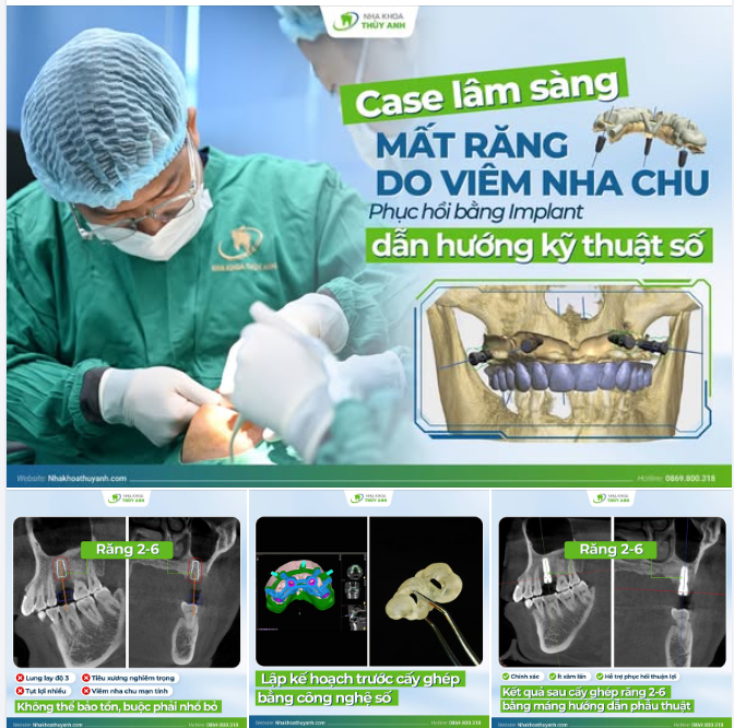 ỨNG DỤNG MÁNG HƯỚNG DẪN PHẪU THUẬT TRONG PHỤC HỒI RĂNG 26 SAU VIÊM NHA CHU MẠN TÍNH