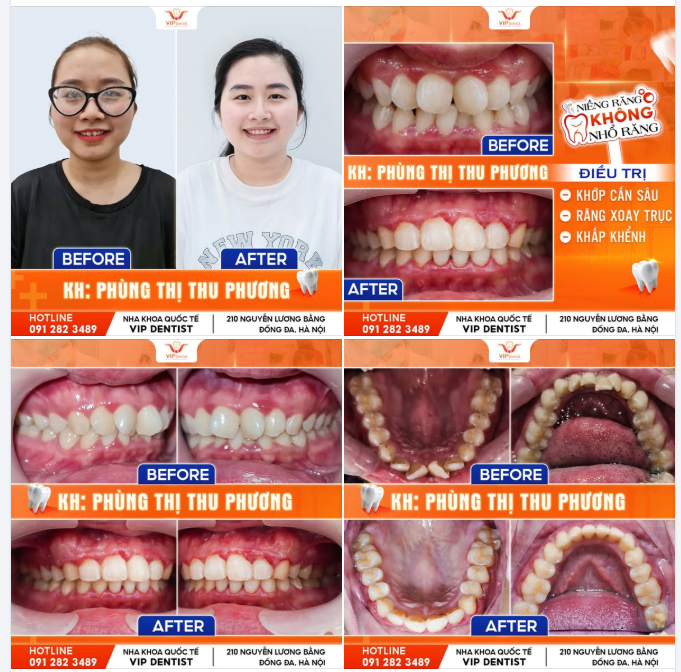 SAI KHỚP CẮN - KHÔNG ĐIỀU TRỊ SỚM RẤT NGUY HIỂM!