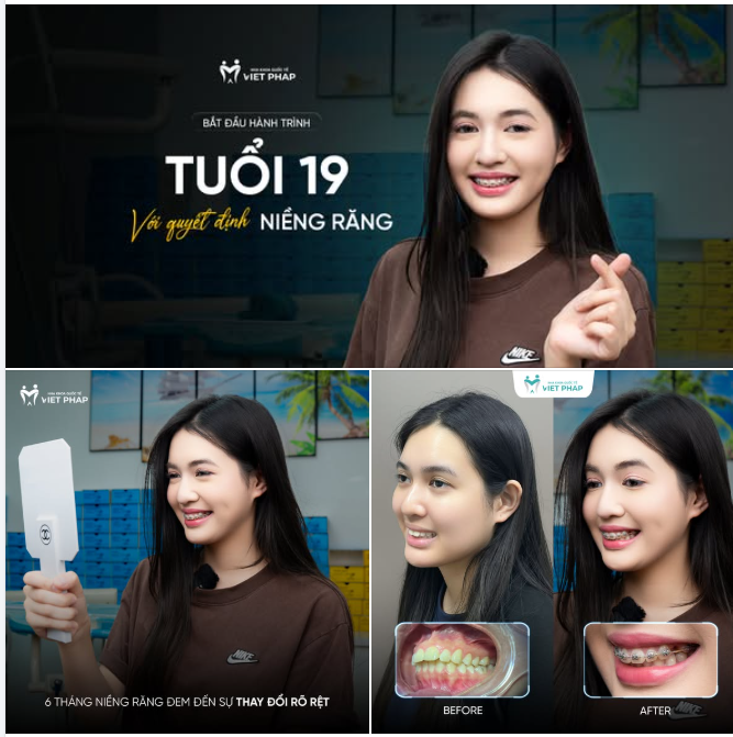 BẮT ĐẦU TUỔI 19 BẰNG QUYẾT ĐỊNH NIỀNG RĂNG