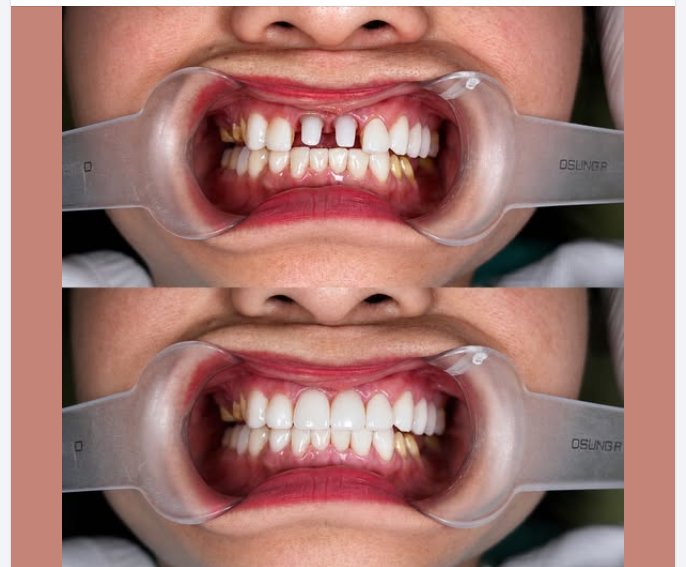Lên sứ cho Implant vùng răng thẩm mỹ cùng với Veneer  Kiến tạo nụ cười rực rỡ cho chị khách