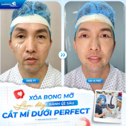 XÓA BỌNG MỠ, LÀM ĐẦY RÃNH LỆ SÂU NHỜ CẮT MÍ DƯỚI PERFECT!