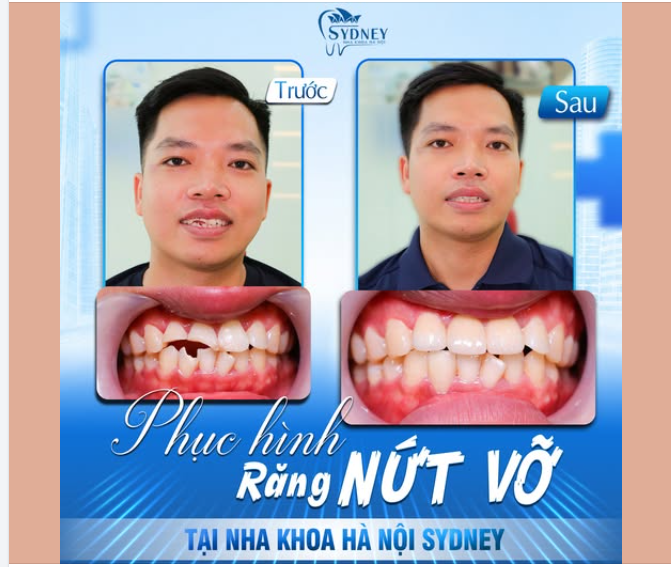 PHỤC HÌNH RĂNG NỨT VỠ TẠI NHA KHOA HÀ NỘI SYDNEY (KH.VĂN NAM)
