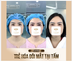 COMBO TRẺ HÓA ĐÔI MẮT – THAY ĐỔI DIỆN MẠO RÕ RỆT