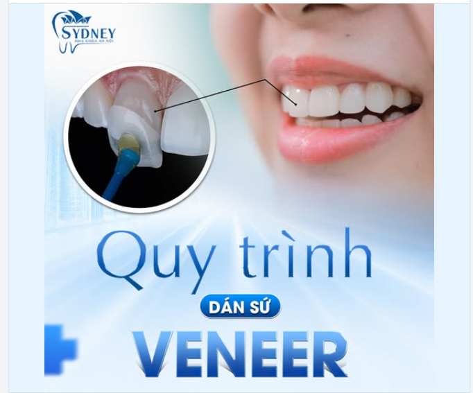 QUY TRÌNH DÁN SỨ VENEER