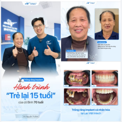 TỪ MẤT RĂNG LÂU NĂM ĐẾN DIỆN MẠO TRẺ RA 15 TUỔI SAU CẤY GHÉP IMPLANT