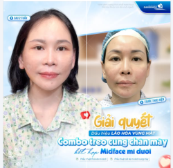 TREO CUNG CHÂN MÀY KẾT HỢP MID FACE MÍ DƯỚI