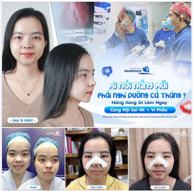 AI NÓI NÂNG MŨI PHẢI NGHỈ DƯỠNG CẢ THÁNG