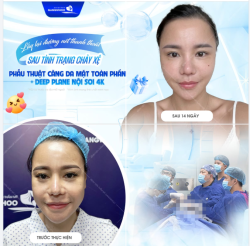 LẤY LẠI ĐƯỜNG NÉT THANH THOÁT SAU TÌNH TRẠNG CHẢY XỆ