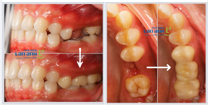 Khoảng trống được lấp đầy. Khớp cắn được cân bằng trở lại.