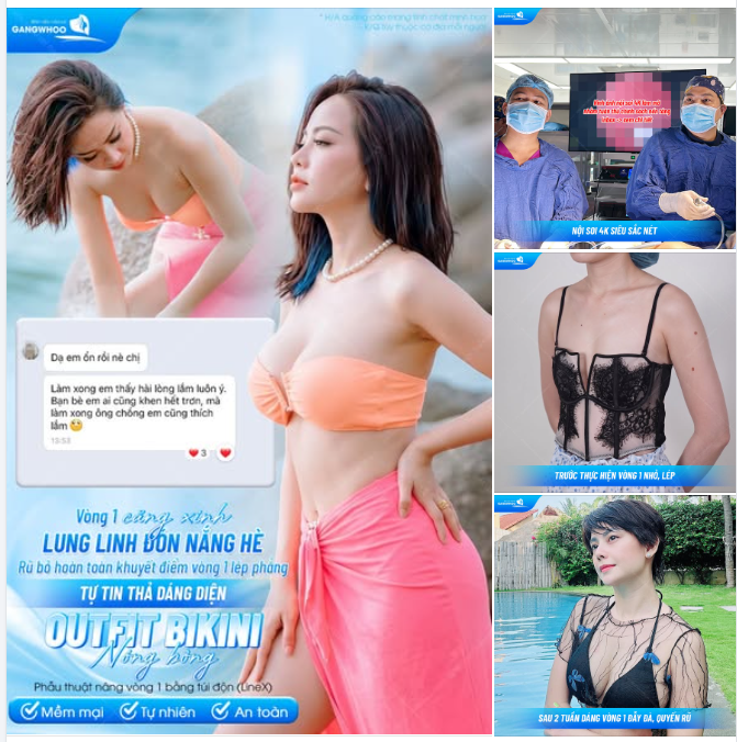 VÒNG 1 CĂNG XINH, LUNG LINH ĐÓN NẮNG HÈ - RŨ BỎ HOÀN TOÀN KHUYẾT ĐIỂM VÒNG 1 LÉP PHẲNG, TỰ TIN THẢ DÁNG DIỆN OUTFIT BIKINI NÓNG BỎNG