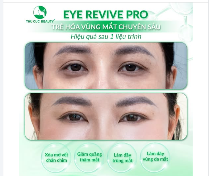 Khuyết điểm duy nhất trên gương mặt tố cáo tuổi tác của bạn chính là đôi mắt trũng, nhăn, thâm quầng!