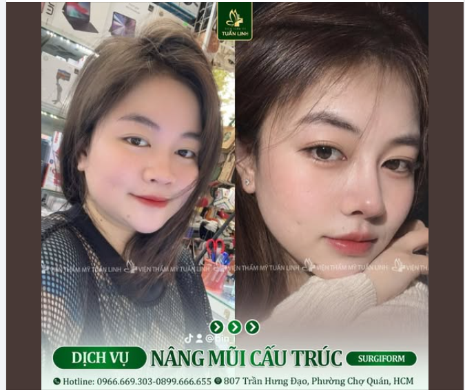 NÂNG MŨI CẤU TRÚC – THAY ĐỔI CHIẾC MŨI, NÂNG TẦM NHAN SẮC