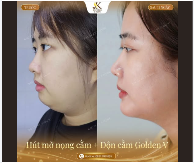 Góc nghiêng đẹp không còn là "góc may mắn"