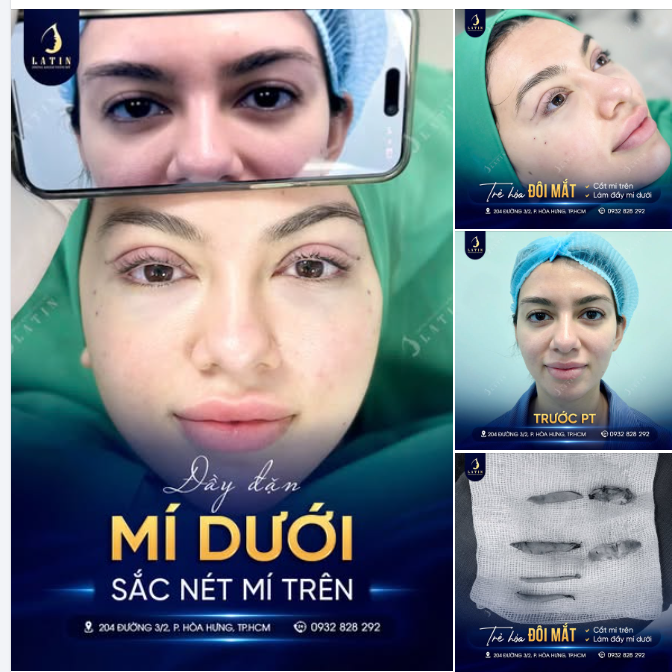COMBO CẮT MÍ TRÊN VÀ LÀM ĐẦY MÍ DƯỚI CHO KHÁCH HÀNG VIỆT KIỀU ÚC