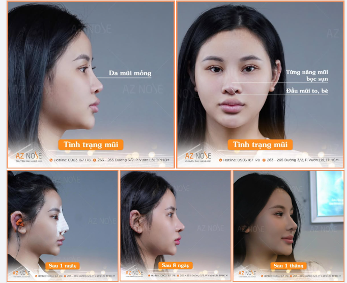 Dáng mũi Trung Hoa sau 1 tháng với sóng mũi cao, bay nhẹ, đầu mũi tròn và tổng thể gương mặt cũng trở nên hài hòa, thanh thoát.