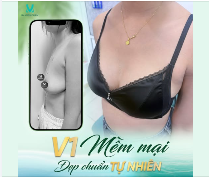 V1 MỀM MẠI – ĐẸP CHUẨN TỰ NHIÊN