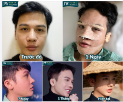 GÂY SỐT: TỪ CẰM LẸM, MŨI THẤP ĐẾN GÓC NGHIÊNG “ĐỐN TIM” - CHÀNG TRAI 9X THAY ĐỔI NGOẠN MỤC