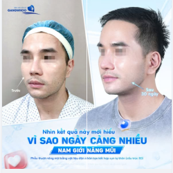 Vì sao ngày càng nhiều nam giới nâng mũi